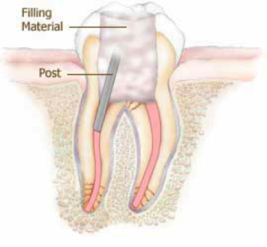 root canal with post for support