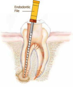 Retrait du tissu infecté et enflammé de la dent par le canal, Clinique Dentaire Dre. Manta, photo