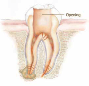 Schéma d'un traitement de canal, Clinique Dentaire Dre. Manta, photo
