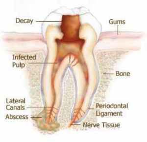root canal infected pulp
